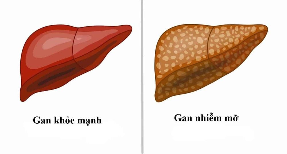 
Tình trạng gan nhiễm mỡ
