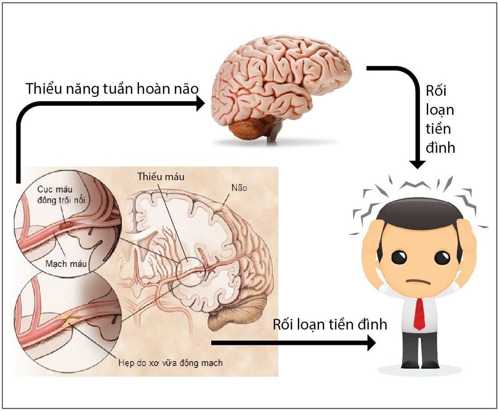 
Nguyên nhân và triệu chứng rối loạn tiền đình
