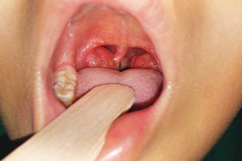 
The tonsils in the oropharynx are infected for a long time and become enlarged
