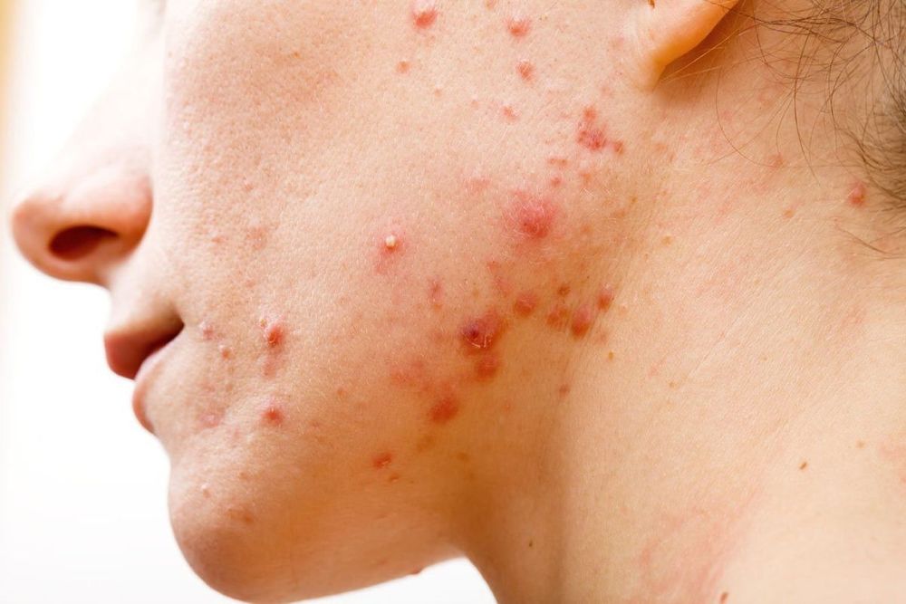 Learn about infectious dermatitis (purulent dermatitis)