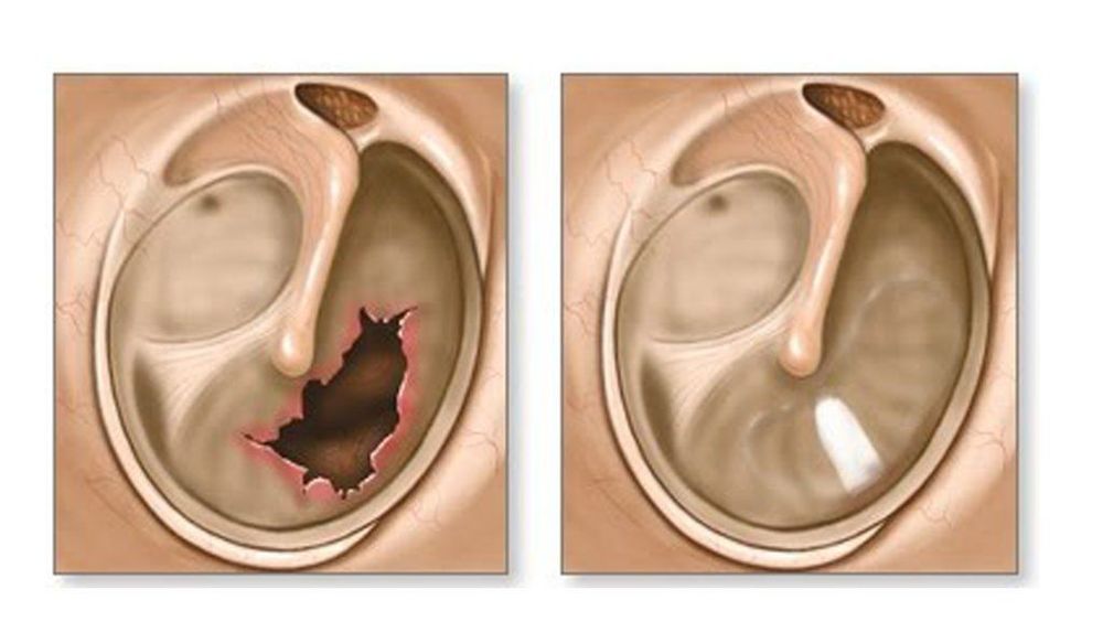 
Ear drum repair is a commonly used method
