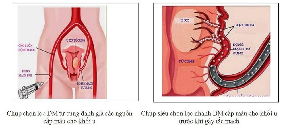 
Nút mạch u xơ tử cung đang là biện pháp điều trị được nhiều bệnh nhân u xơ tử cung quan tâm
