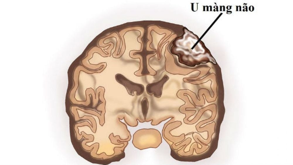 
Bệnh nhân u màng não được chỉ định phẫu thuật nội soi tuyến yên
