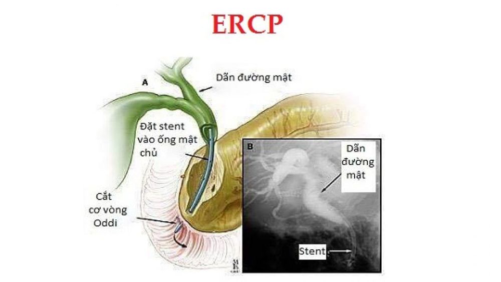 
Minh họa thủ thuật ERCP. Đường mật bị tắt/hẹp tạo nên hình ảnh dãn đường mật phía trên dòng. Ống stent (màu xanh dương) đặt vào ống mật chủ để làm thông đường mật. Hình đen trắng bên phải (hình B) là hình ảnh trên màn hình chụp trong quá trình thực hiện thủ thuật.
