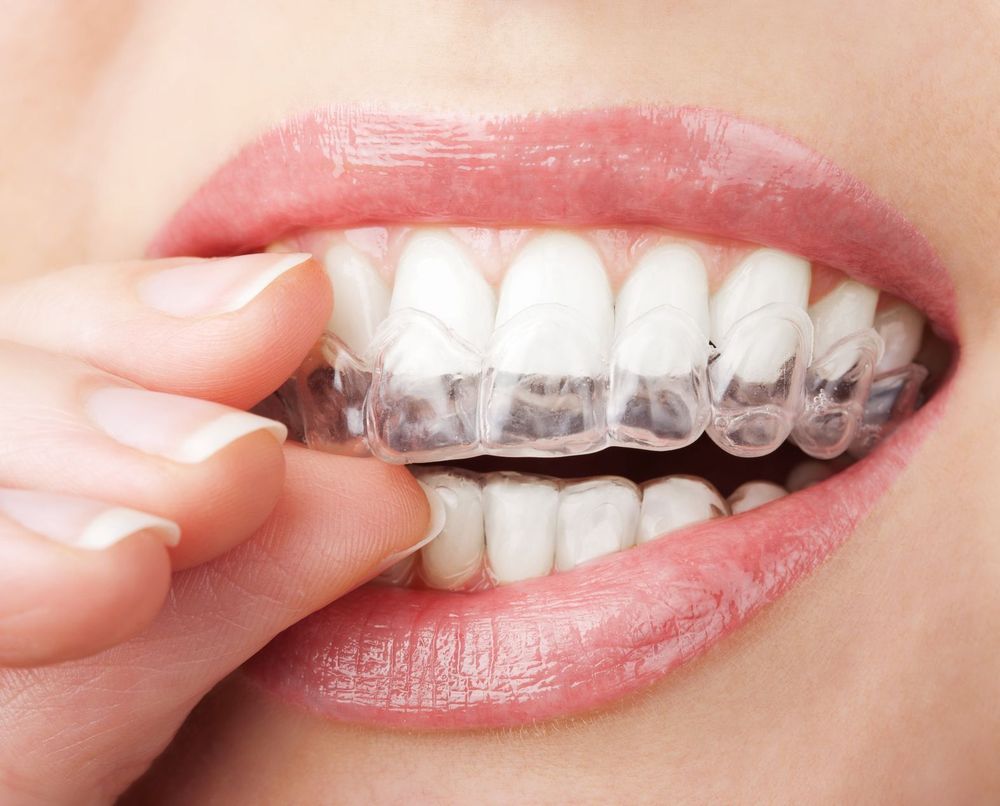 
Niềng răng trong suốt Invisalign
