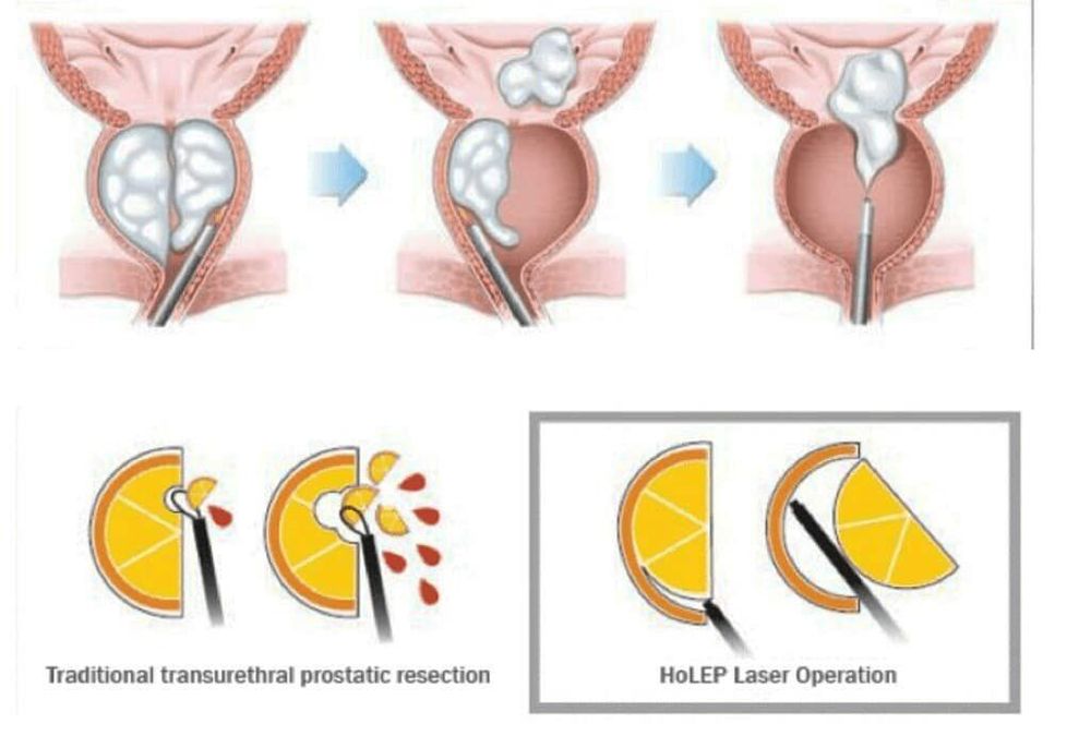 
Phẫu thuật Laser Holmium có nhiều ưu điểm so với các phương pháp truyền thống
