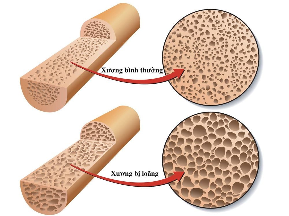 
Lợi ích của liệu pháp estrogen thay thế trong việc phòng ngừa loãng xương sau mãn kinh đã được biết rõ.
