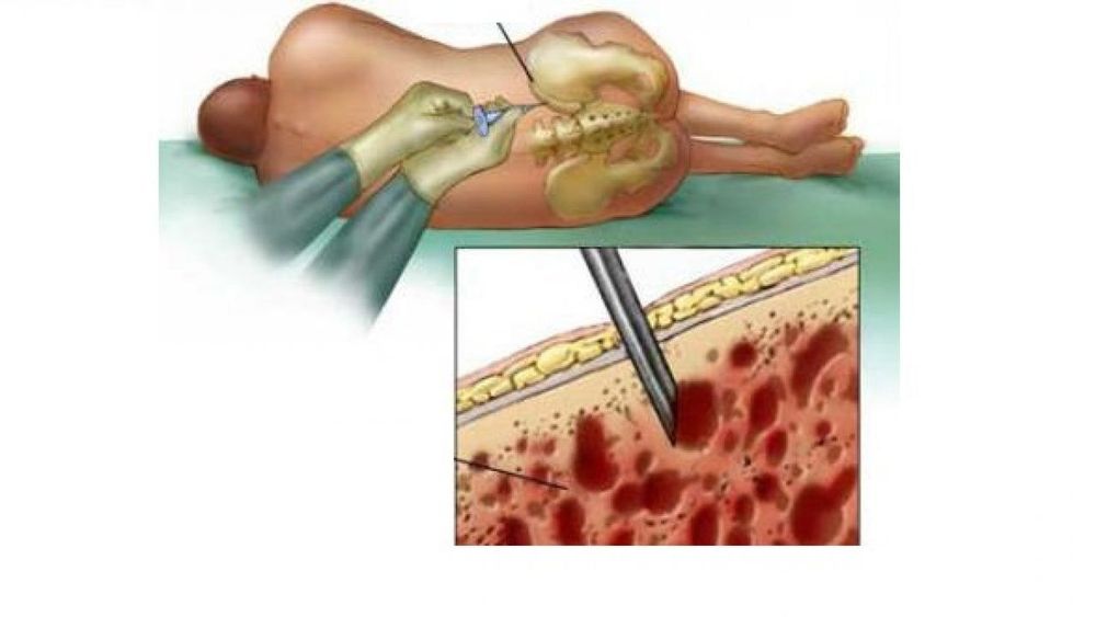 
Bệnh nhân có thể được chỉ định cho dùng thuốc an thần kết hợp gây tê tại chỗ
