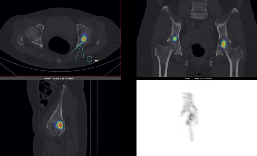 
Hình ảnh tổn thương ở khớp háng bên trái và trần khớp háng bên phải phát hiện trên SPECT/CT
