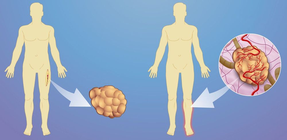 
Sarcoma là một loại ung thư bắt đầu trong các mô như xương hoặc cơ
