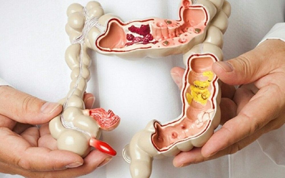 Polyp viêm có thể xuất hiện sau một cơn viêm loét đại tràng. 
