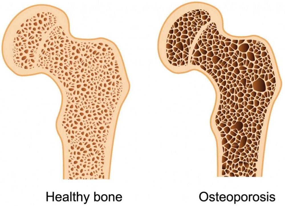 
Whey protein không gây ra loãng xương
