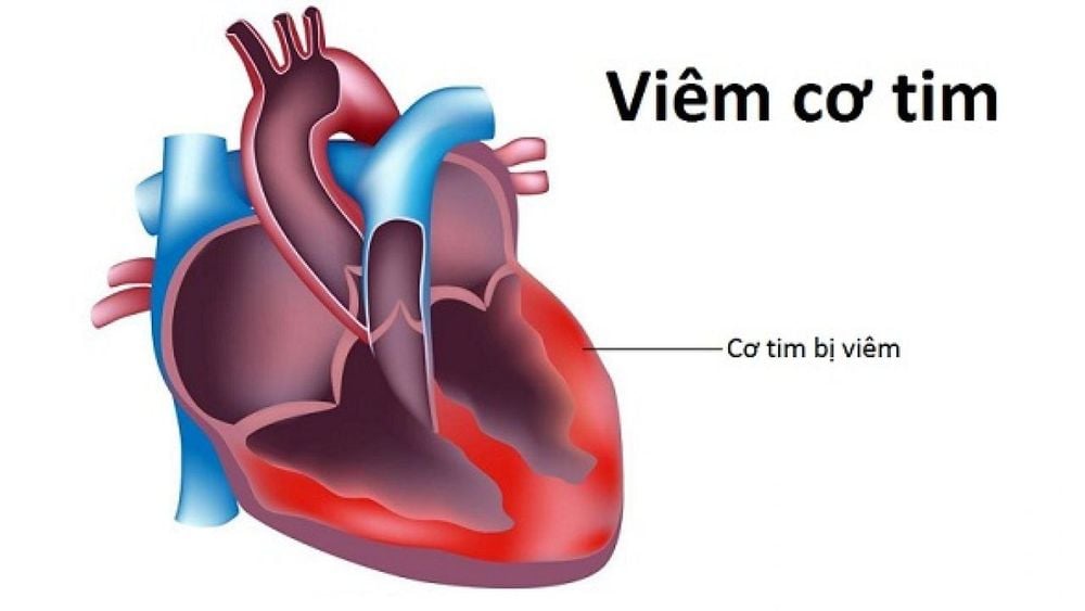 
Viêm cơ tim là một bệnh có diễn biến nhanh chóng, phức tạp, gây nguy hiểm đến tính mạng người bệnh nếu không được điều trị sớm và kịp thời
