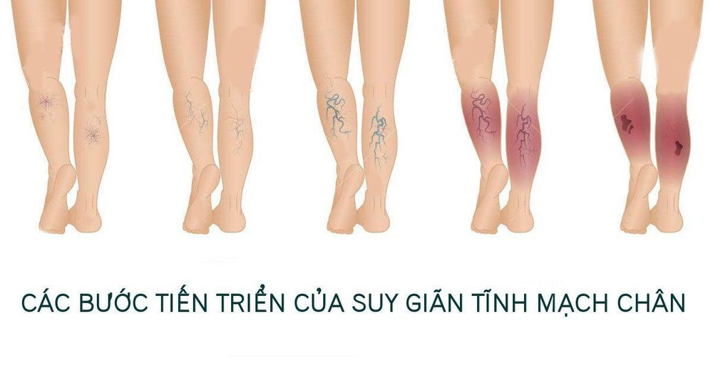 
Các giai đoạn suy giãn tĩnh mạch chi dưới
