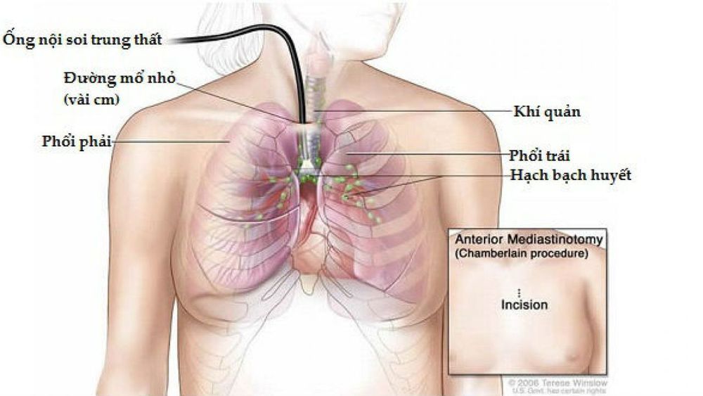 
Nội soi trung thất
