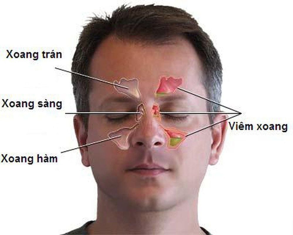 
Ethmoid sinusitis is a common disease
