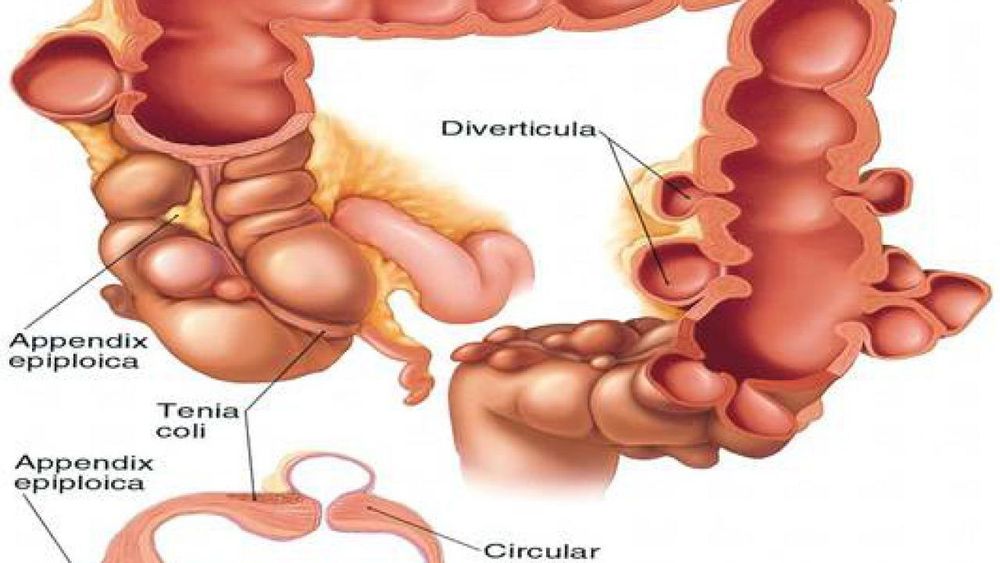 
Điều trị túi thừa đại tràng
