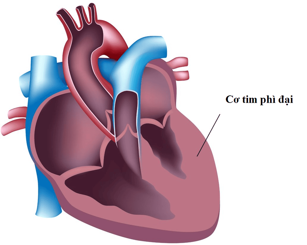 
Bệnh cơ tim phì đại tương đối hiếm gặp ở trẻ em, tỷ lệ mắc bệnh là 1/500
