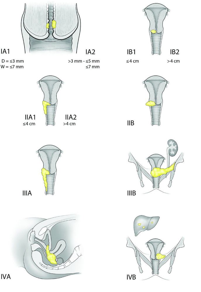 
Ung thư âm hộ được chia làm 4 giai đoạn
