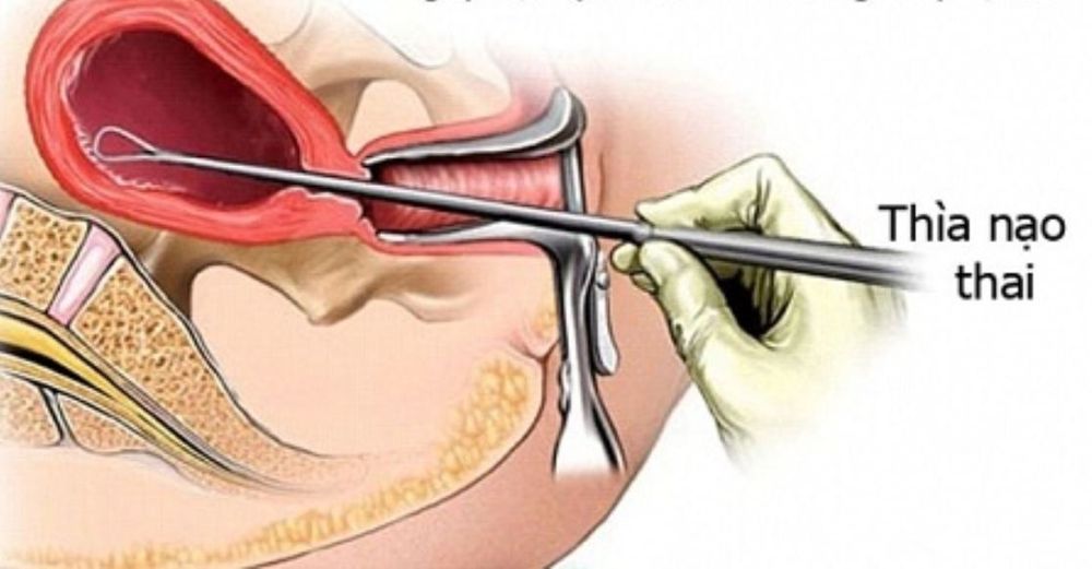 
Phương pháp nạo thai điều trị sẩy thai sớm
