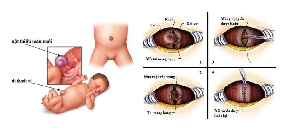 
Hình ảnh thoát vị rốn ở trẻ sơ sinh
