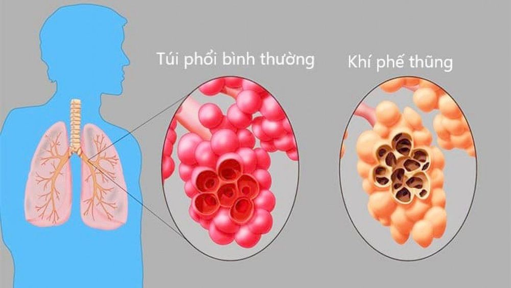 
Bệnh nhân khí phế thũng
