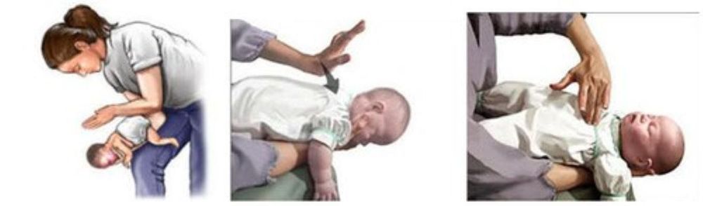 Emergency procedures for infants choking on milk