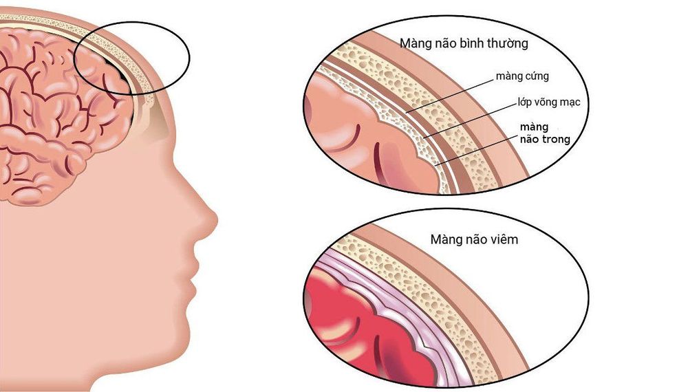 
Viêm màng não mủ gây ra nhiều di chứng nghiêm trọng
