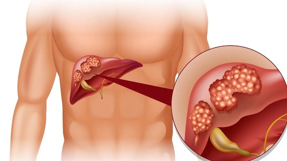 
Các loại viêm gan phổ biến là viêm gan A, viêm gan B, viêm gan C
