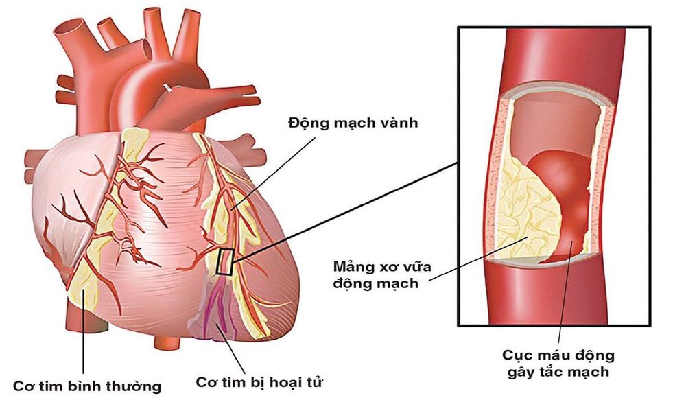 
Bản chất của mảng xơ vữa là các phân tử lipid lưu hành trong máu với nồng độ cao, xâm nhập vào thành mạch
