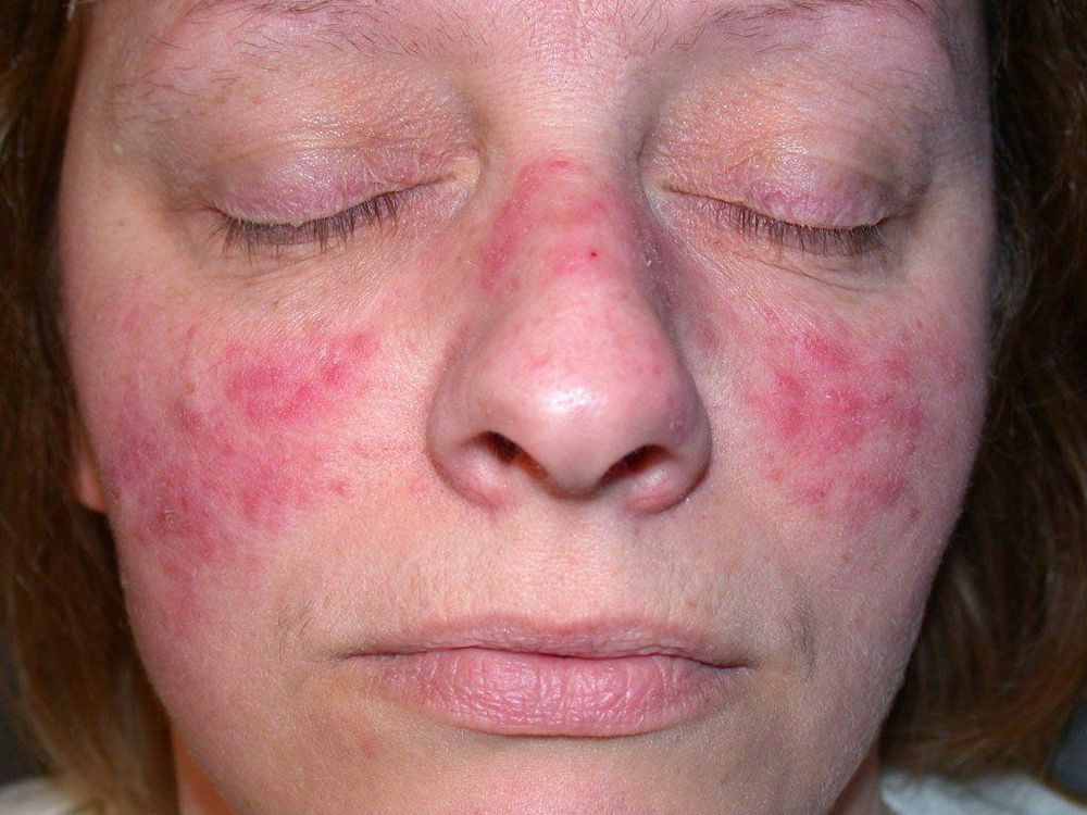 
Phát ban dạng hình bướm trên mặt là dấu hiệu điển hình của Lupus ban đỏ
