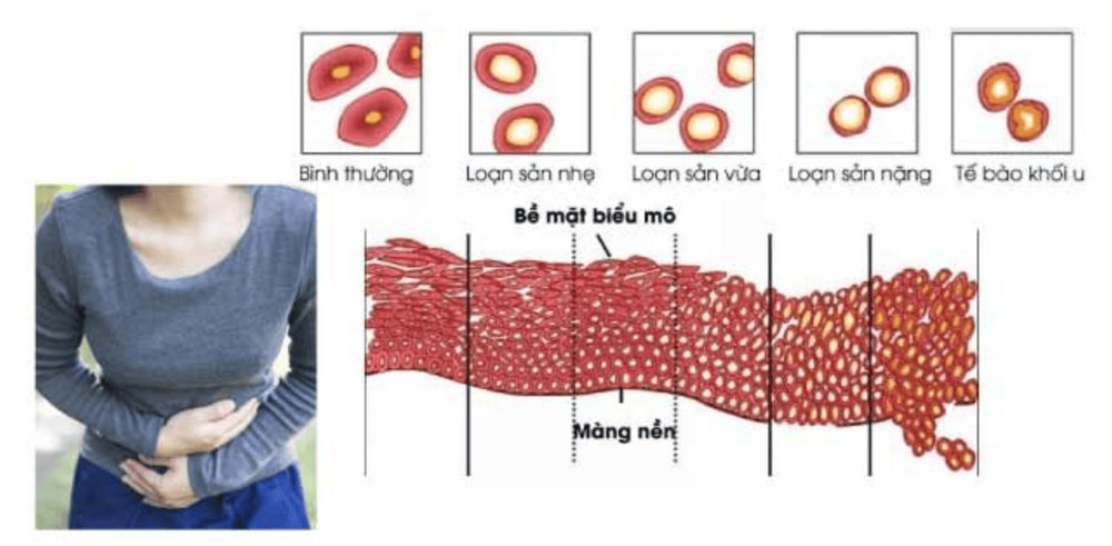 
Cấp độ loạn sản cổ tử cung
