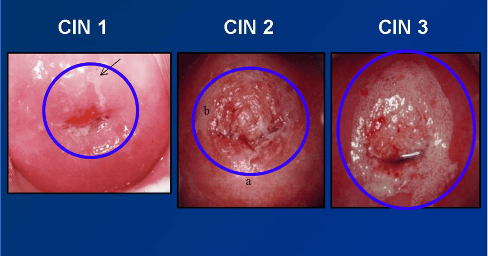 
Hình ảnh thực tế 3 cấp độ là CIN 1 2 3
