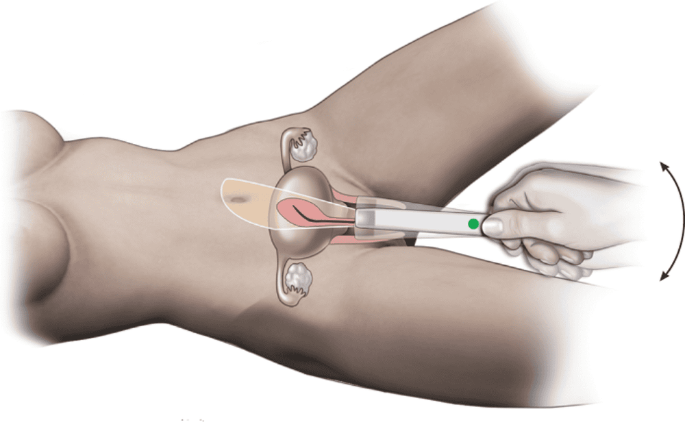 
Siêu âm đầu dò âm đạo giúp chẩn đoán polyp buồng tử cung
