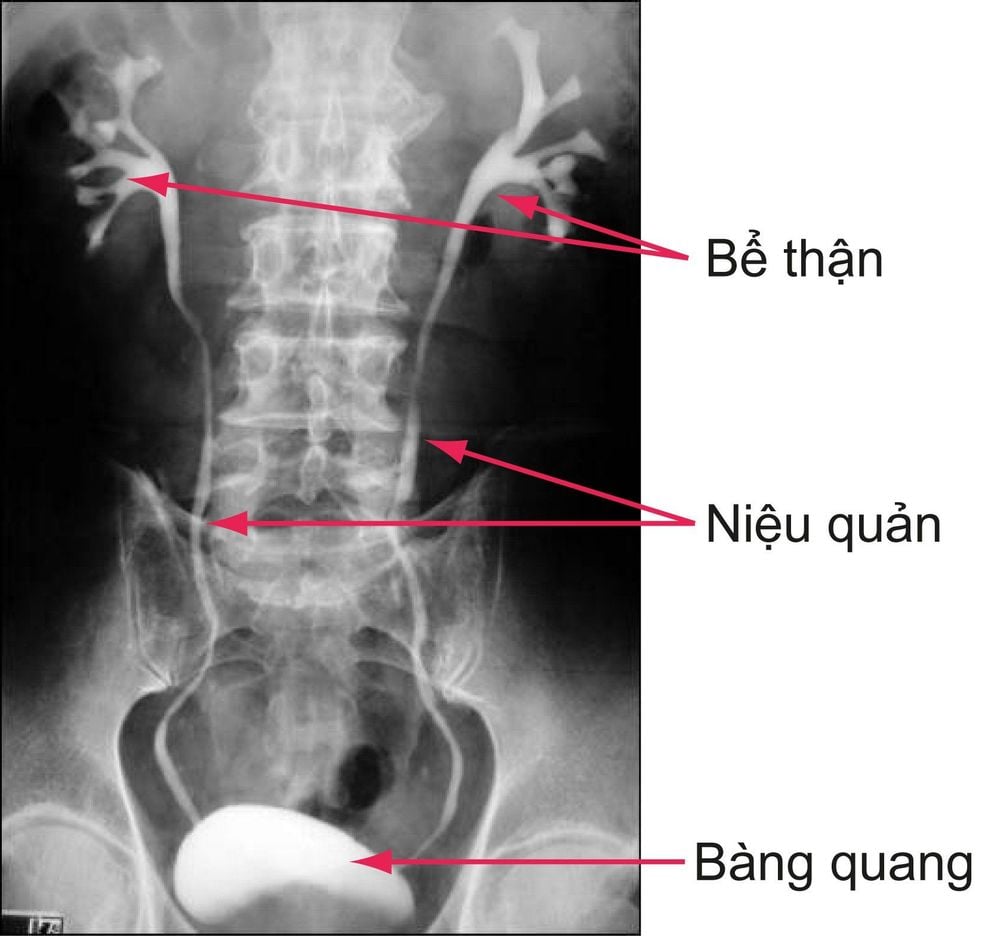 
Chụp X-quang đường tiết niệu
