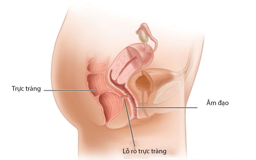 
Rò trực tràng âm đạo
