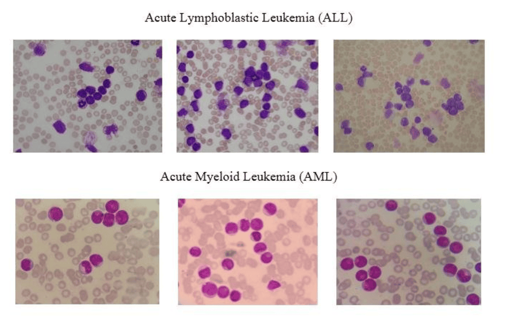 Acute lymphoblastic leukemia