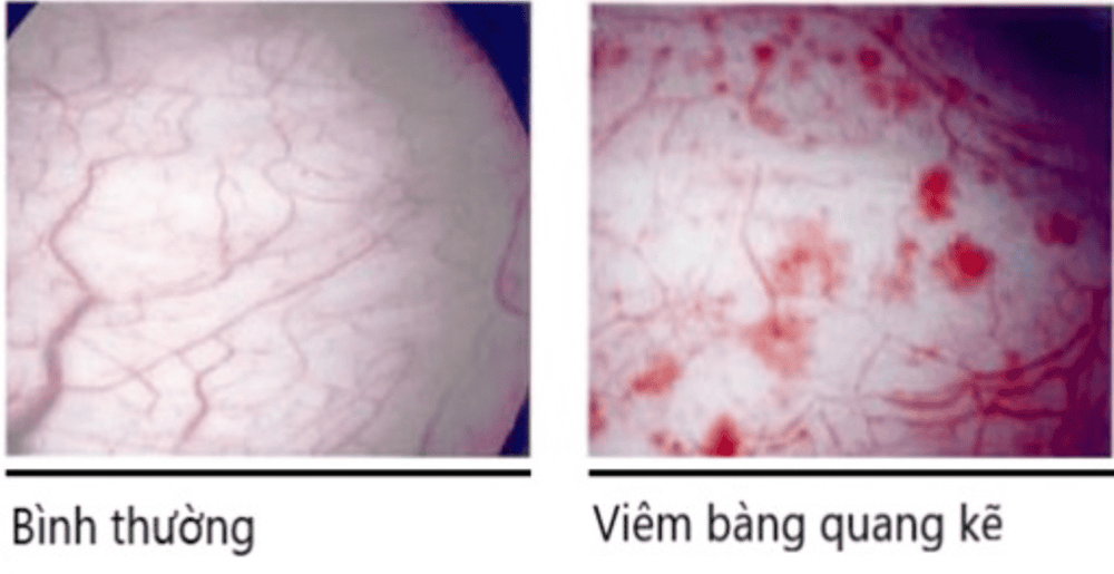 
Hình ảnh viêm bàng quang kẽ qua nội soi
