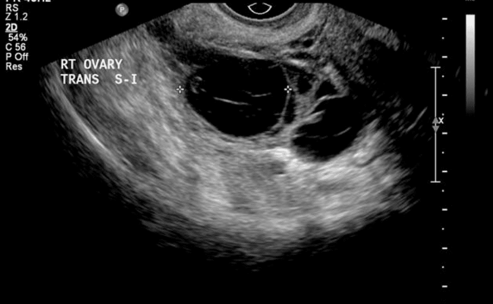 
Ovarian abscess on ultrasound image
