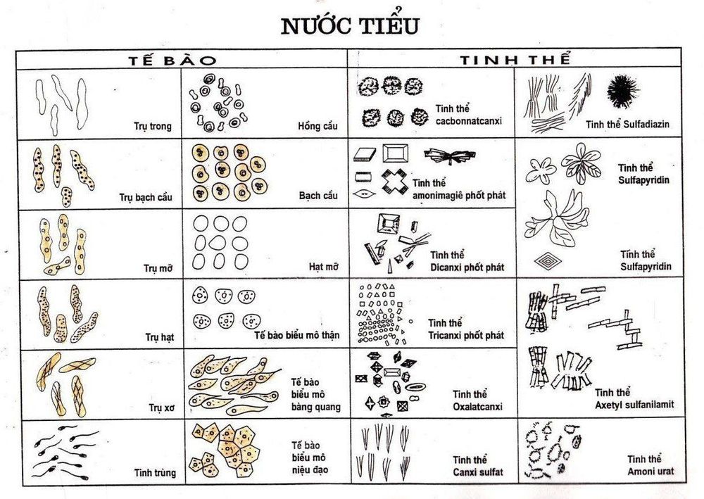 
Xét nghiệm cặn nước tiểu bằng phương pháp thủ công là kỹ thuật cận lâm sàng quan trọng
