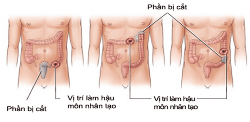 
Vị trí làm hậu môn nhân tạo phải đạt được các yêu cầu nhất định
