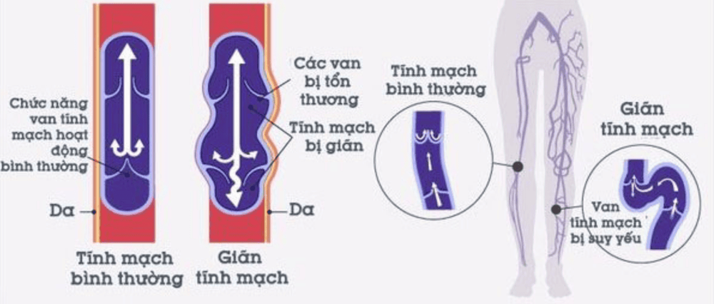 
Van tĩnh mạch chi dưới bị tổn thương gây suy giãn tĩnh mạch chi dưới
