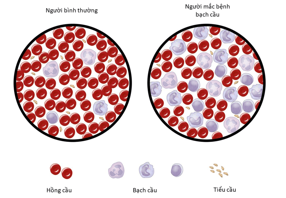 
Bệnh nhân bệnh bạch cầu cấp dòng tủy cần xét nghiệm nhiễm sắc thể đồ
