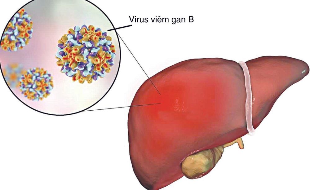 Bệnh viêm gan siêu vi B do một loại virus mang DNA thuộc họ Hepadnaviridae gây ra.
