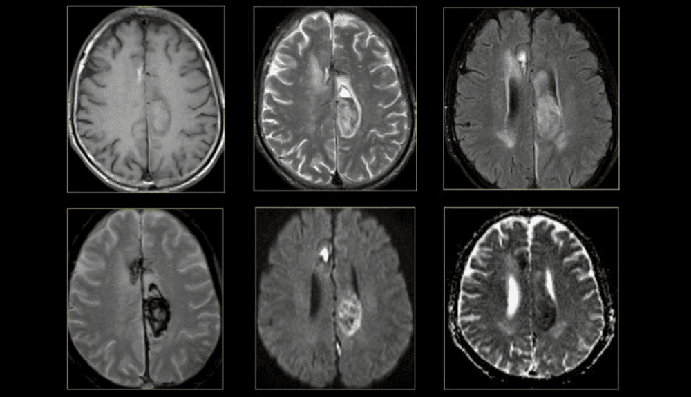 
Hình ảnh não bộ trên MRI
