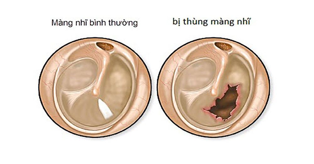 
Thủng màng nhĩ do viêm tai giữa
