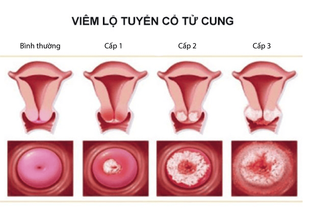 
Các cấp độ viêm lộ tuyến cổ tử cung
