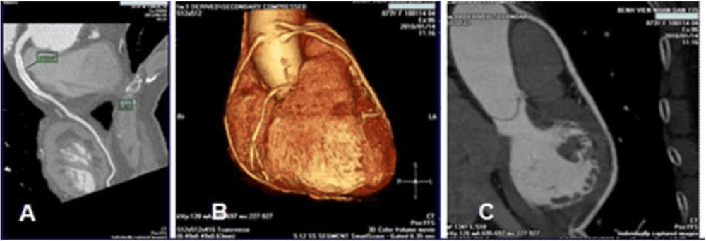 
A/ Hình CT mạch vành của 1 bệnh nhân nam, 73 tuổi, đau ngực không đặc hiệu, có 1 stent (> 5 năm) ở động mạch vành LAD1-2, không bị tái hẹp; B -C/ Hình 3D của 1 bệnh nhân nữ 73 tuổi, có 3 cầu mạch vành, 2 cầu bên trái và 1 cầu bên phải, cầu không bị tái hẹp
