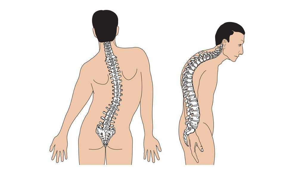 
Hội chứng người hóa đá dẫn tới mất khả năng vận động
