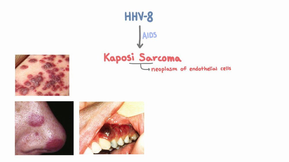 
Nhiễm virus herpes 8 gây ung thư Kaposi
